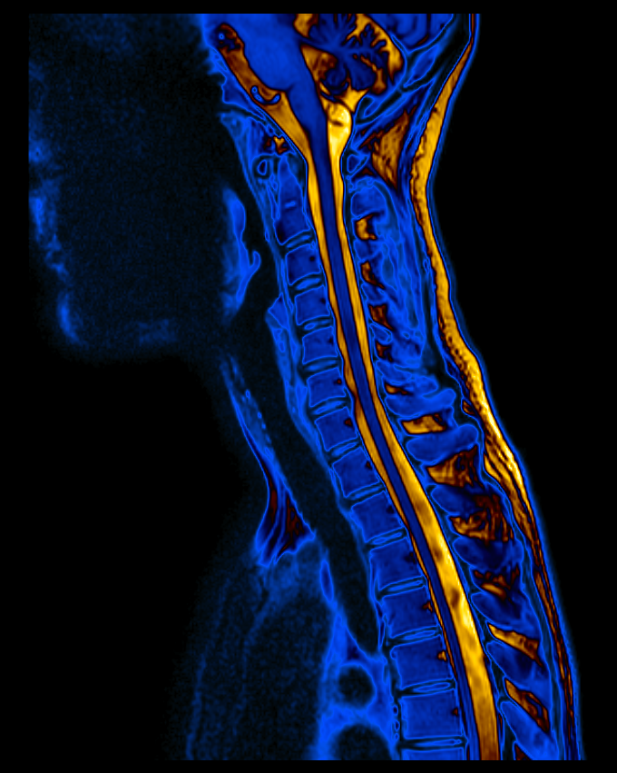 Spine MRI Analysis